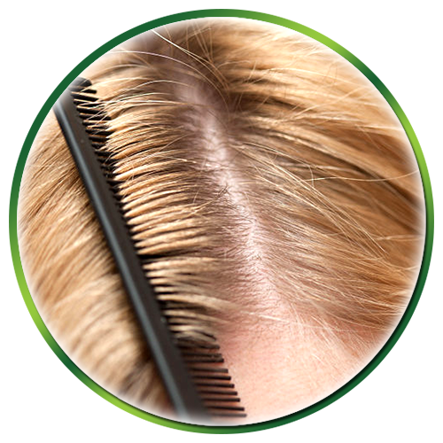Sănătatea scalpului – Mătreața
